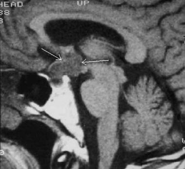 Sagittal nonenhanced T1-weighted image demonstrate