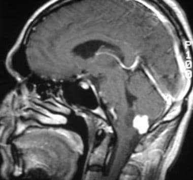 Sagittal T1-weighted gadolinium-enhanced MRI shows