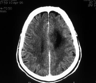 Computed tomography scan of a low-grade oligodendr