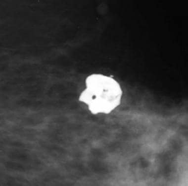 Microcalcification distribution over the smallest breast volume (d =