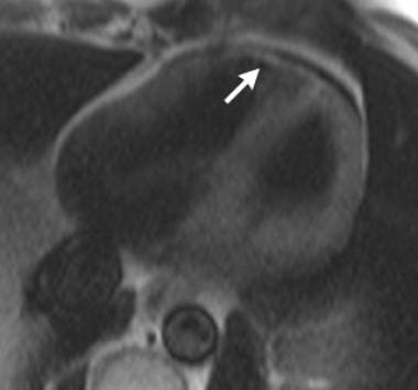 Arrhythmogenic right ventricular dysplasia: "Black