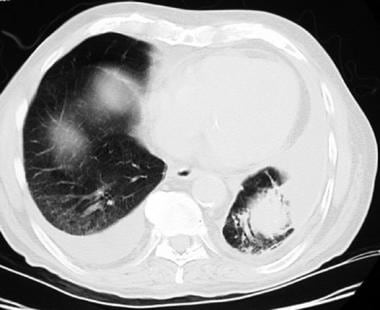 Aspiration pneumonia. CT scan through the lower lo