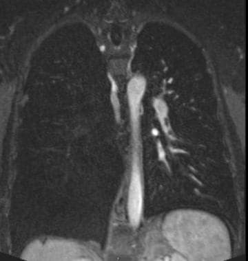 Coronal MR angiography in a patient with renal car