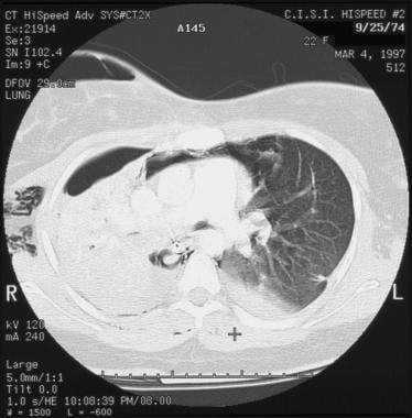5-mm axial computed tomography (CT) scan with the 