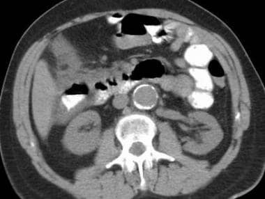 Mesenteric ischemia. CT scan in a 72-year-old man 