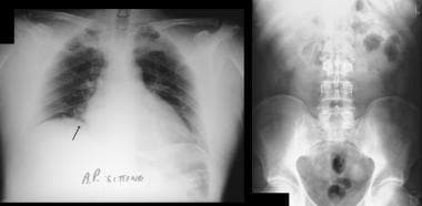 Pneumoperitoneum. (Left) Supine chest radiograph s