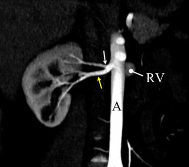 Three-dimensional grayscale volume CT angiography 