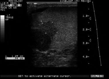 This is another seminoma. On sonograms, a seminoma