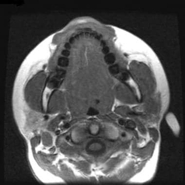 腮腺恶性肿瘤。轴向t1加权MRI d