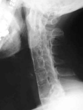 Vertebral fusion. Lateral radiograph shows solid a