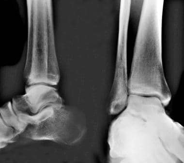 Calcaneus, fractures. Anteroposterior (AP) and lat