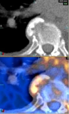 Positron emission tomography (PET)/CT image (axial