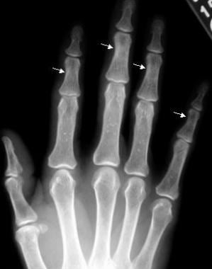 Anteroposterior radiographic view of the right han