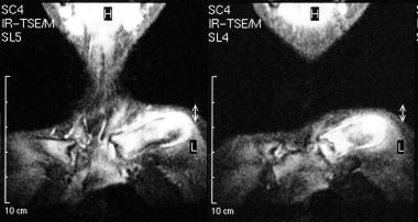 Osteomyelitis, chronic. Short-tau inversion recove