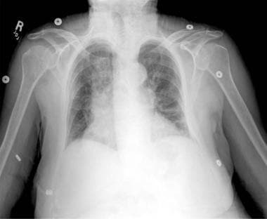 Anteroposterior (AP) chest radiograph in a patient