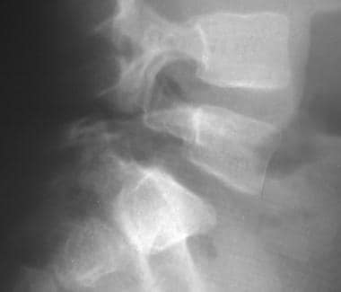 Spondylolisthesis. Lateral lumbar spinal radiograp