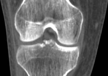 Tibial plateau fractures. Coronal reformatted CT. 