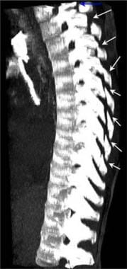 Thoracic spine trauma. Volume maximum intensity pr