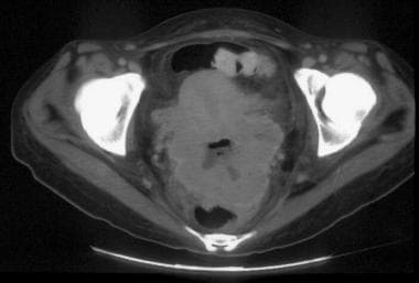 CT of a large, lobulated mass that is replacing th