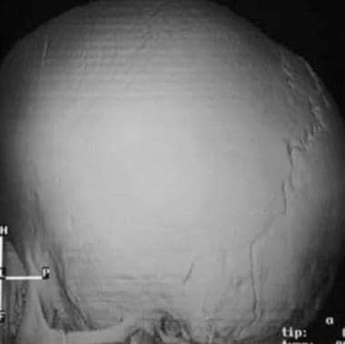 Three-dimensional CT scan shows brachycephaly. The