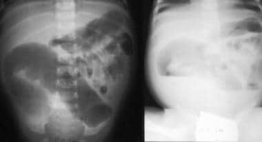 Hirschsprung disease. Frontal abdominal radiograph