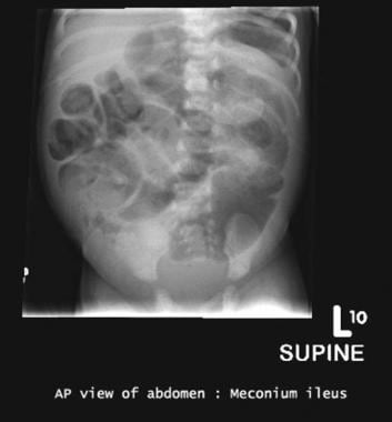 Abdominal radiograph shows low intestinal obstruct