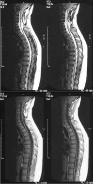 T1- and T2-weighted sagittal MRIs of the cervical 