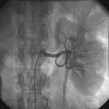 Left renal artery stenosis. 