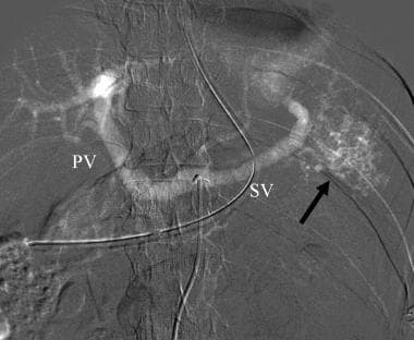 Carbon dioxide celiac angiogram in a patient with 