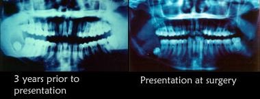 Initial radiographic appearance. The patient was a