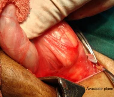 Open inguinal hernia repair. Avascular plane betwe