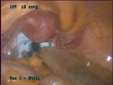 Transvaginal cholecystectomy. Dissection of gallbl