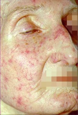 Telangiectasia of the face. 