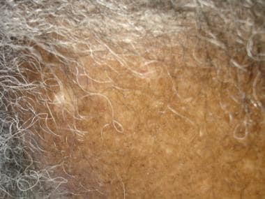 End-stage scarring alopecia (ESSA) with prior hist