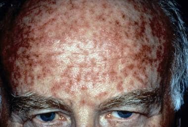 Queratosis actínica justo después del tratamiento con tópico