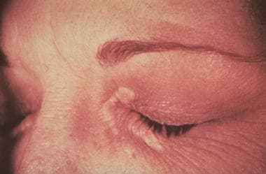 eruptive xanthomatosis face