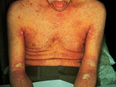 Crusted scabies. Courtesy of William D. James, MD.