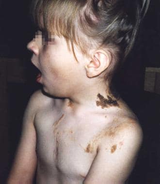 An 8-year-old girl with Jadassohn nevus syndrome. 
