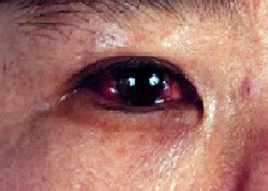Ocular involvement showing posterior uveitis. 