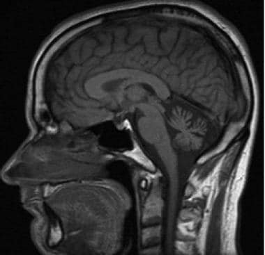 MRI of a 29-year-old female with ARCA1. Sagittal T
