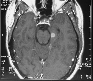 Multiple meningiomas in a patient with neurofibrom
