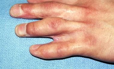 Syndactyly: Background, Problem, Epidemiology