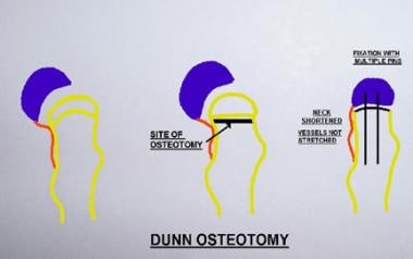 Principle of the Dunn osteotomy. Reduction of the 