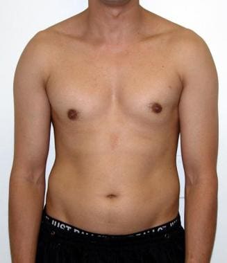 Is this gynecomastia? Please look closely and you will see my left breast  is bigger than the right. Any advice?? : r/gynecomastia