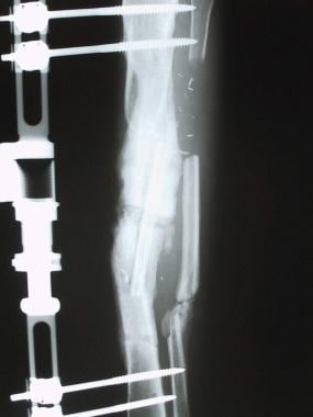 Clinical Case 1. Early postoperative radiograph of