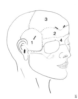 The upper part of the subperiosteal facelift (endo