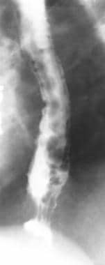 Uphill esophageal varices. Barium swallow demonstr