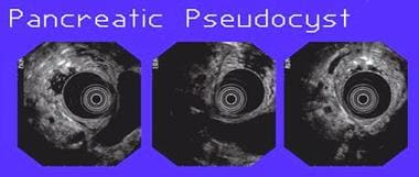 Three views of a pancreatic pseudocyst noted durin