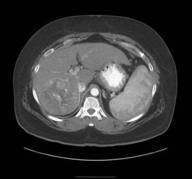 MRI of a liver with hepatocellular carcinoma. 
