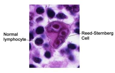 A Reed-Sternberg cell in Hodgkin lymphoma. Reed-St